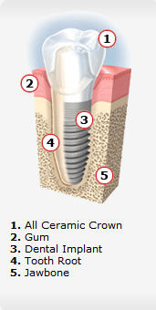 Dental Implants in Medford, Oregon